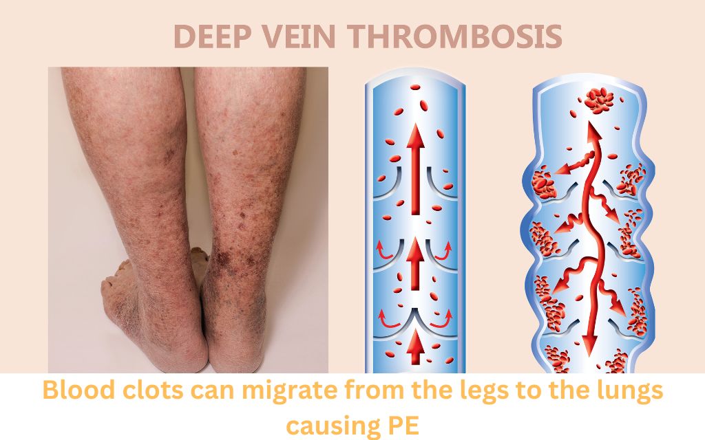 Pulmonary embolism can be caused by DVT